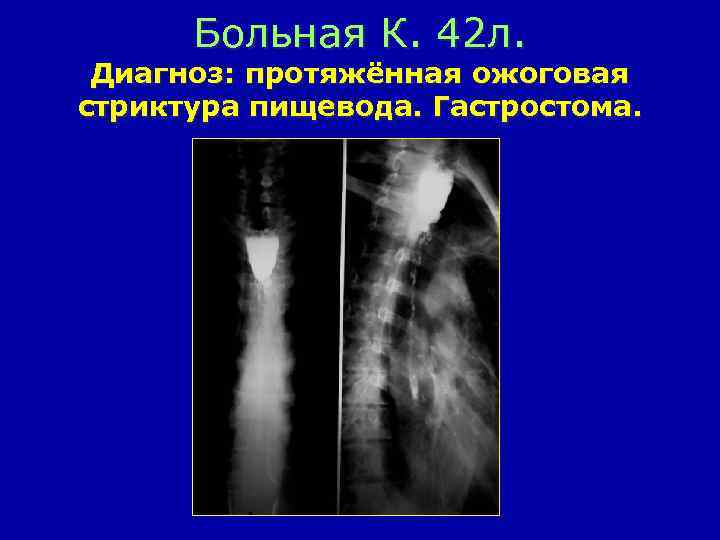 Больная К. 42 л. Диагноз: протяжённая ожоговая стриктура пищевода. Гастростома. 