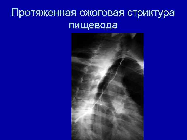 Протяженная ожоговая стриктура пищевода 