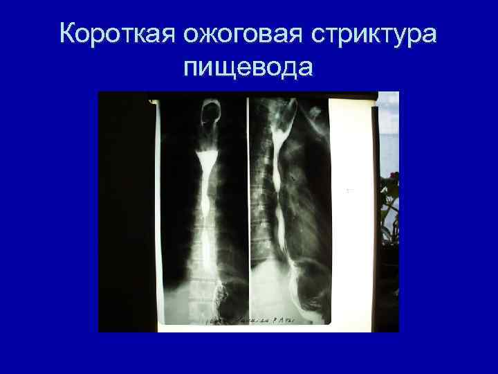 Короткая ожоговая стриктура пищевода 