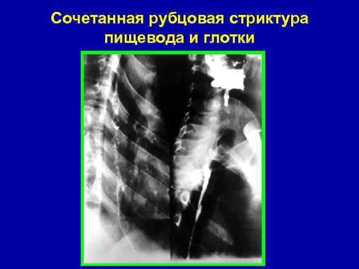 Сочетанная рубцовая стриктура пищевода и глотки 