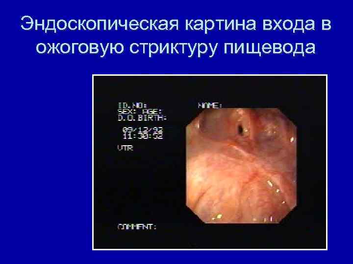 Эндоскопическая картина входа в ожоговую стриктуру пищевода 