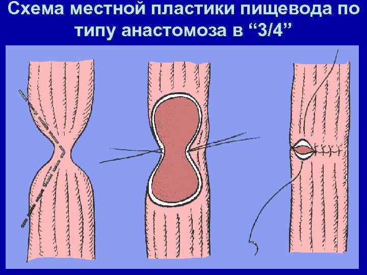 Схема местной пластики пищевода по типу анастомоза в “ 3/4” 
