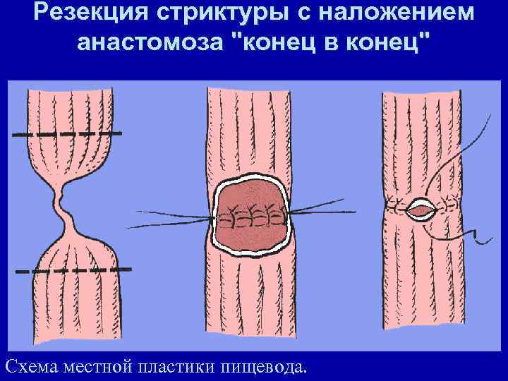 Резекция стриктуры с наложением анастомоза "конец в конец" Схема местной пластики пищевода. 