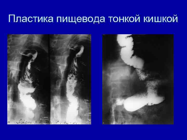 Пластика пищевода тонкой кишкой 