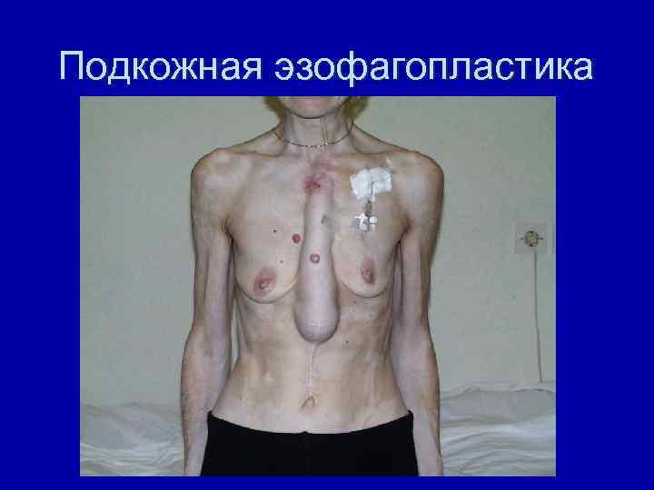 Подкожная эзофагопластика 