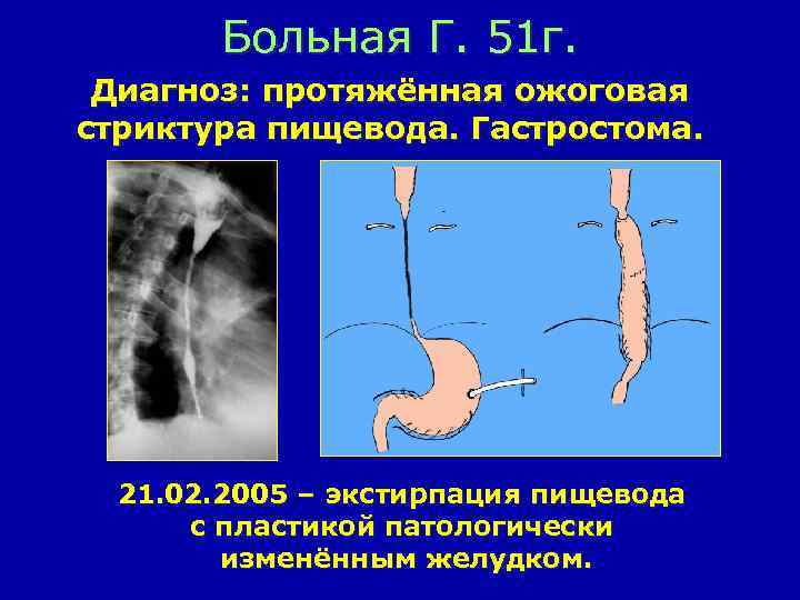Больная Г. 51 г. Диагноз: протяжённая ожоговая стриктура пищевода. Гастростома. 21. 02. 2005 –