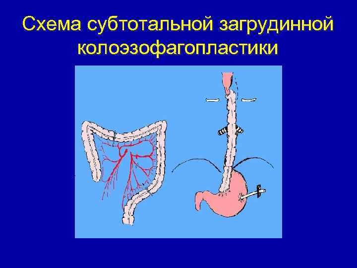 Схема субтотальной загрудинной колоэзофагопластики 