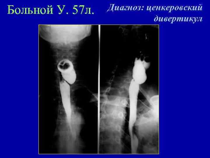 Больной У. 57 л. Диагноз: ценкеровский дивертикул 