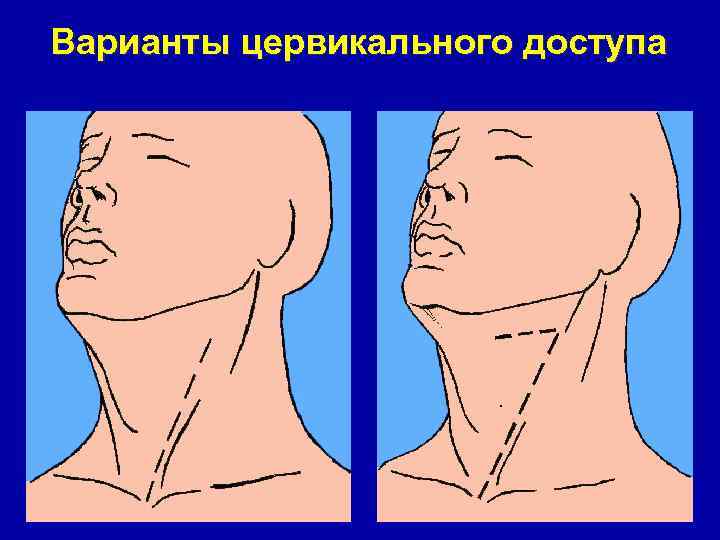 Варианты цервикального доступа 