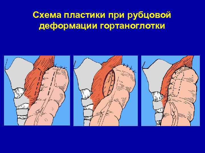 Анастомоз конец в конец схема