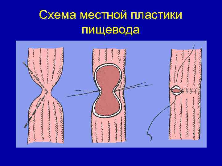 Схема местной пластики пищевода 