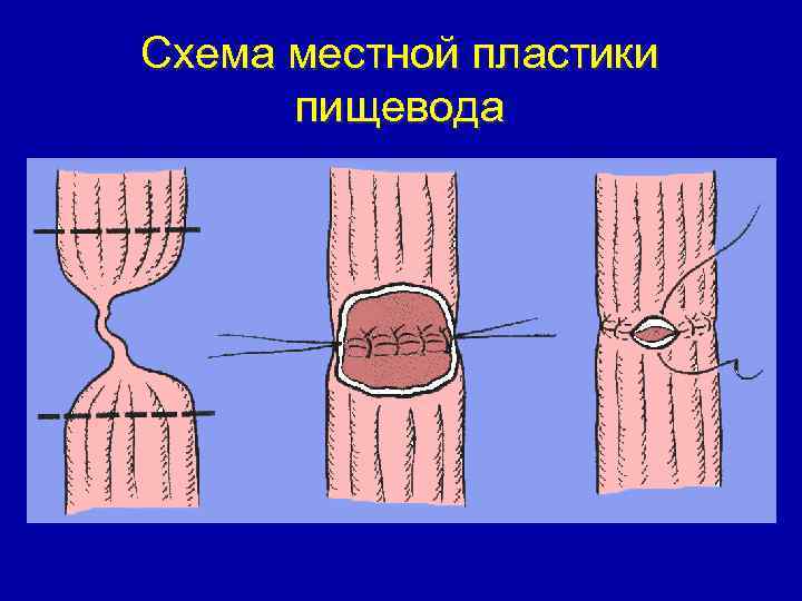 Схема местной пластики пищевода 