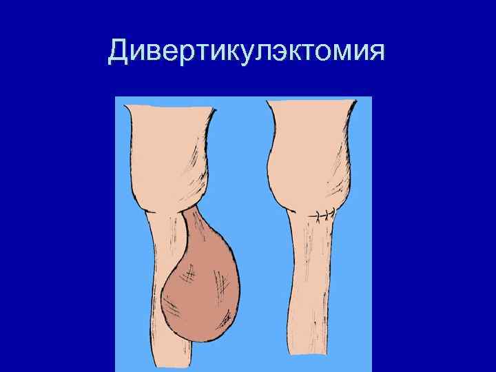 Дивертикулэктомия 
