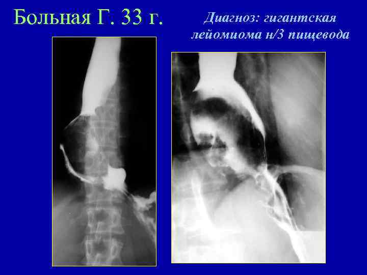 Больная Г. 33 г. Диагноз: гигантская лейомиома н/3 пищевода 