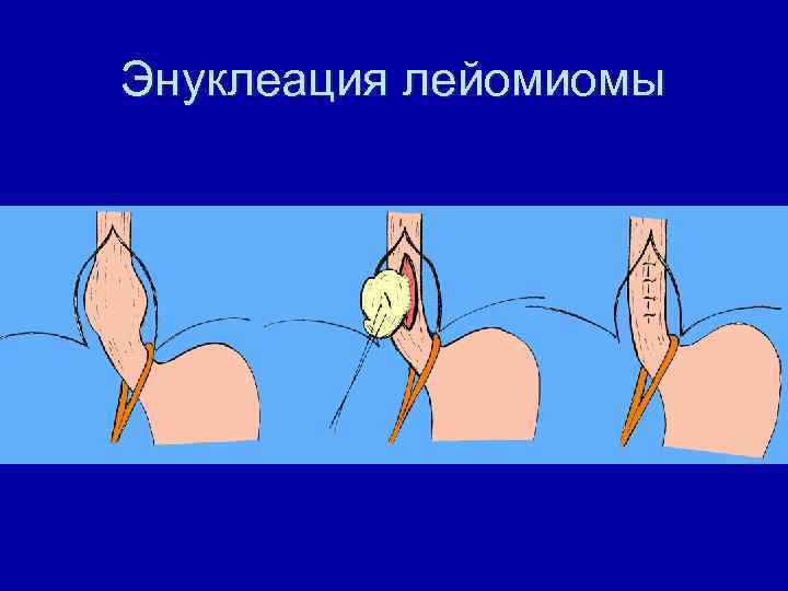 Энуклеация лейомиомы 