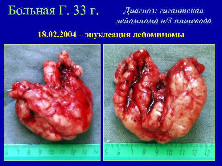 Больная Г. 33 г. Диагноз: гигантская лейомиома н/3 пищевода 18. 02. 2004 – энуклеация
