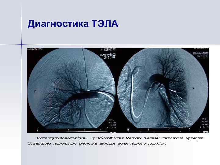 Диагностика ТЭЛА Ангиопульмонография. Тромбоэмболия мелких ветвей легочной артерии. Обеднение легочного рисунка нижней доли левого