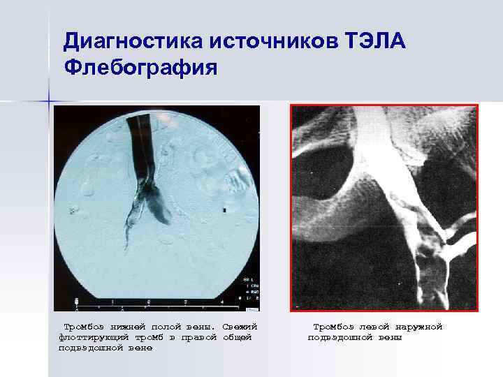 Тромбоза вен печени. Тромбоз нижней полой вены на кт. Тромб нижней полой вены кт. Тромбоэмболия легочной артерии диагностика. Тромбоэмболия артерии дифференциальная диагностика.