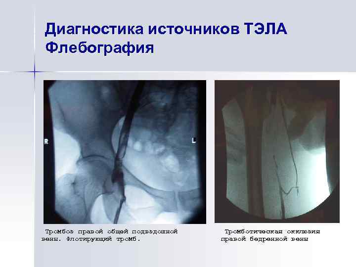 Диагностика источников ТЭЛА Флебография Тромбоз правой общей подвздошной вены. Флотирующий тромб. Тромботическая окклюзия правой