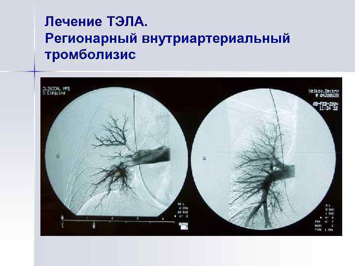 Лечение ТЭЛА. Регионарный внутриартериальный тромболизис 