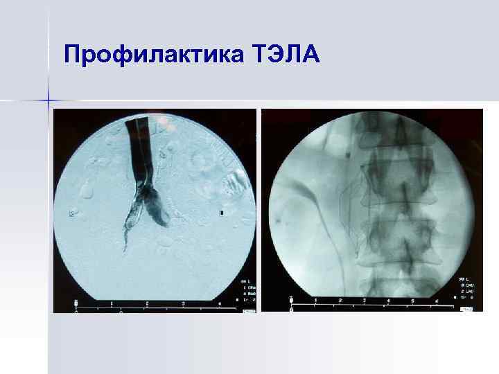 Профилактика ТЭЛА 