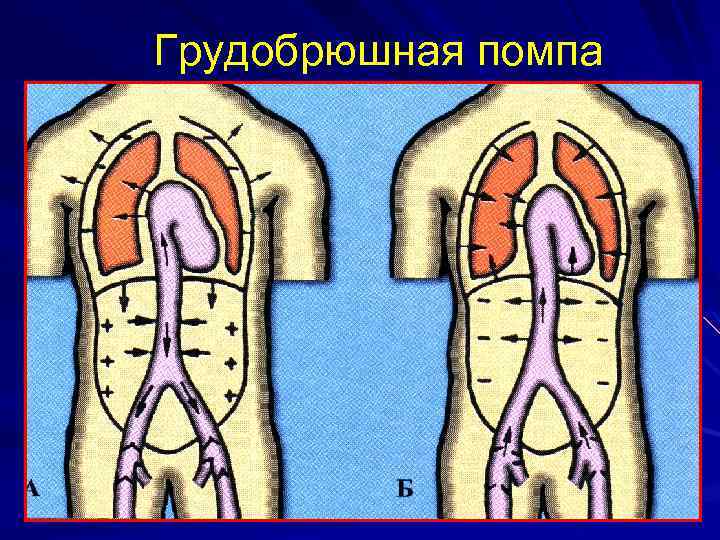Грудобрюшная помпа 