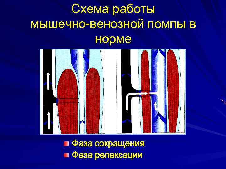 Схема работы мышечно-венозной помпы в норме Фаза сокращения Фаза релаксации 
