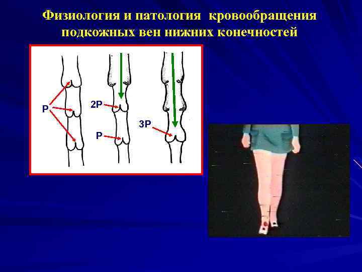 Физиология и патология кровообращения подкожных вен нижних конечностей Р 2 Р 3 Р Р