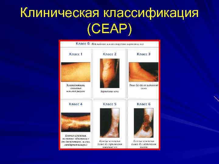 Клиническая классификация (СЕАР) 