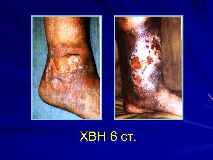 ХВН 6 ст. 