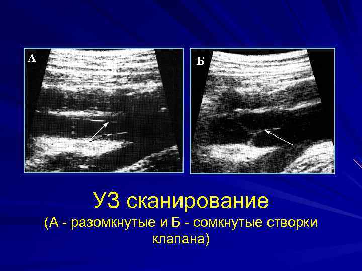 А Б УЗ сканирование (А - разомкнутые и Б - сомкнутые створки клапана) 