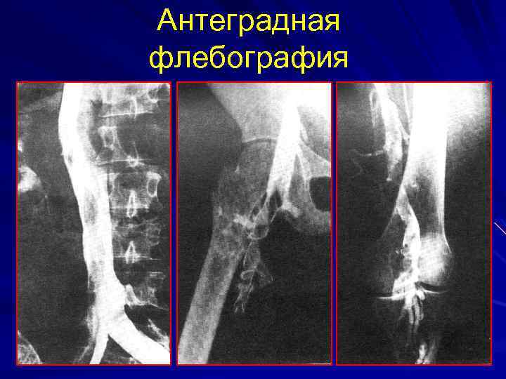 Антеградная флебография 