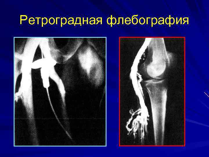 Ретроградная флебография 