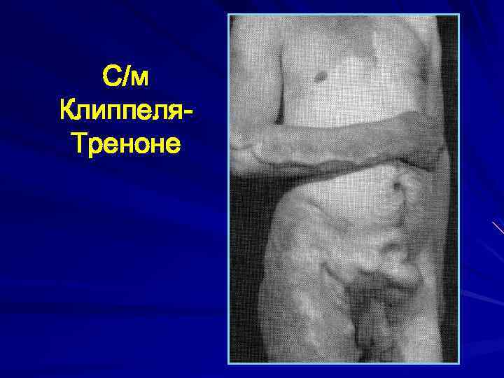 С/м Клиппеля. Треноне 