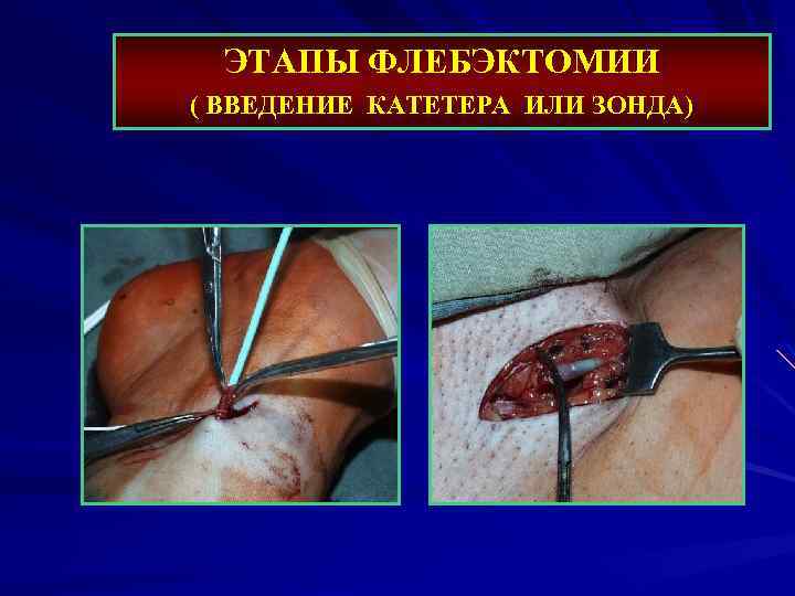 ЭТАПЫ ФЛЕБЭКТОМИИ ( ВВЕДЕНИЕ КАТЕТЕРА ИЛИ ЗОНДА) 