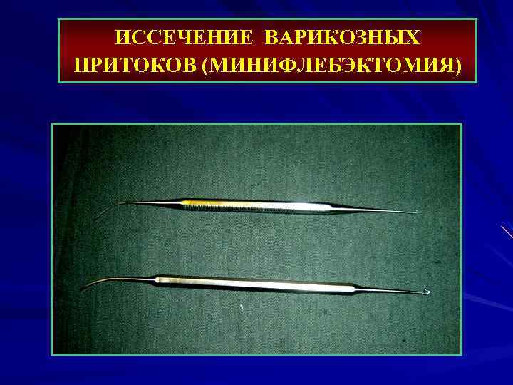 ИССЕЧЕНИЕ ВАРИКОЗНЫХ ПРИТОКОВ (МИНИФЛЕБЭКТОМИЯ) 