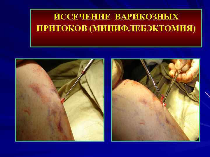 ИССЕЧЕНИЕ ВАРИКОЗНЫХ ПРИТОКОВ (МИНИФЛЕБЭКТОМИЯ) 