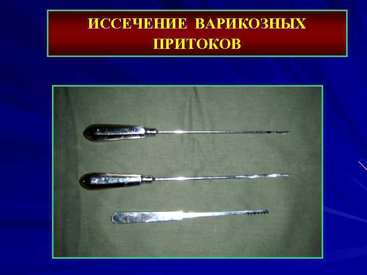 ИССЕЧЕНИЕ ВАРИКОЗНЫХ ПРИТОКОВ 