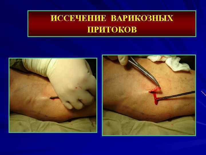 ИССЕЧЕНИЕ ВАРИКОЗНЫХ ПРИТОКОВ 