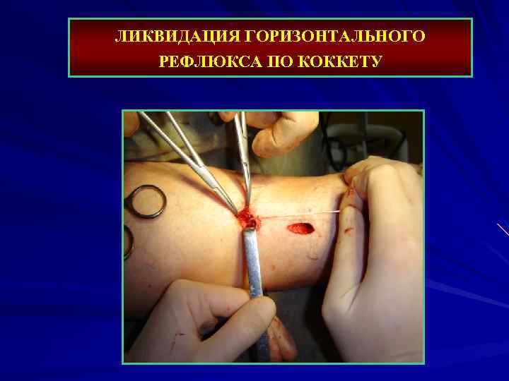 ЛИКВИДАЦИЯ ГОРИЗОНТАЛЬНОГО РЕФЛЮКСА ПО КОККЕТУ 