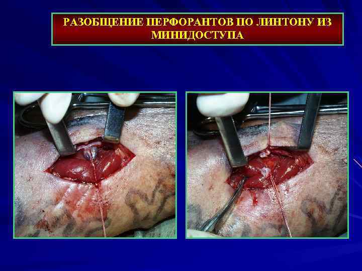 РАЗОБЩЕНИЕ ПЕРФОРАНТОВ ПО ЛИНТОНУ ИЗ МИНИДОСТУПА 