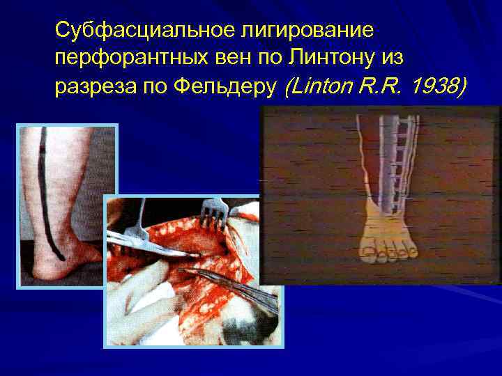 Субфасциальное лигирование перфорантных вен по Линтону из разреза по Фельдеру (Linton R. R. 1938)