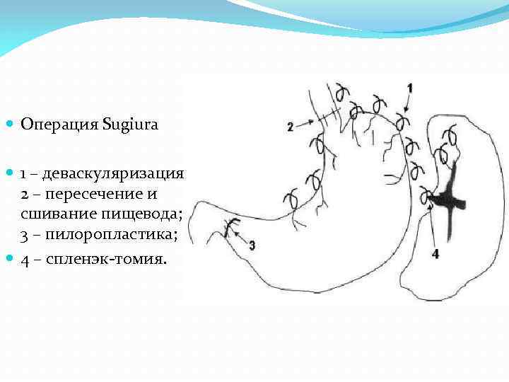  Операция Sugiura 1 – деваскуляризация; 2 – пересечение и сшивание пищевода; 3 –