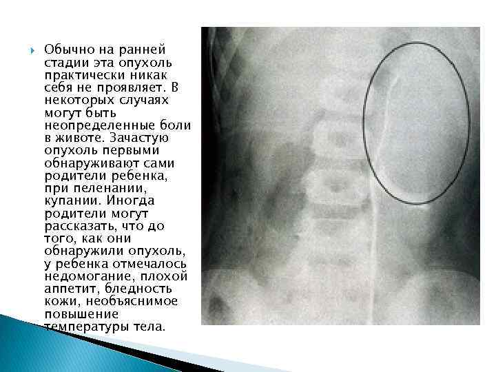  Обычно на ранней стадии эта опухоль практически никак себя не проявляет. В некоторых