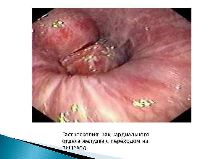 Гастроскопия: рак кардиального отдела желудка с переходом на пищевод. 