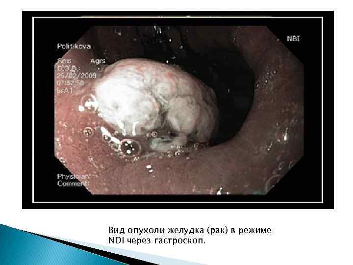 Вид опухоли желудка (рак) в режиме NDI через гастроскоп. 
