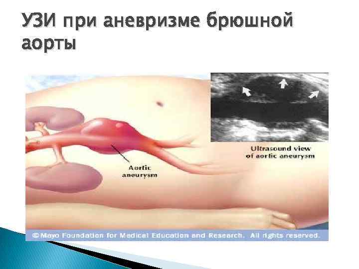 УЗИ при аневризме брюшной аорты 