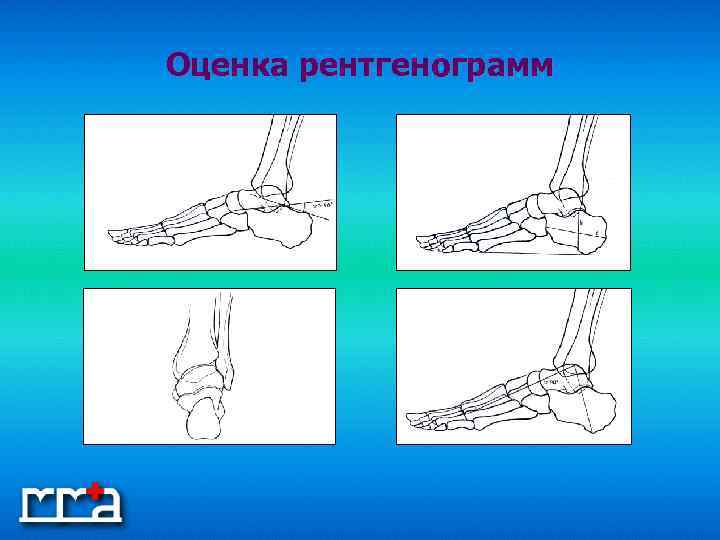 Оценка рентгенограмм 