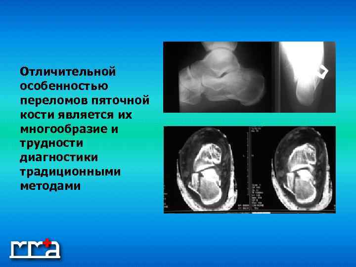 Отличительной особенностью переломов пяточной кости является их многообразие и трудности диагностики традиционными методами 