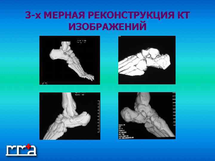 3 -х МЕРНАЯ РЕКОНСТРУКЦИЯ КТ ИЗОБРАЖЕНИЙ 